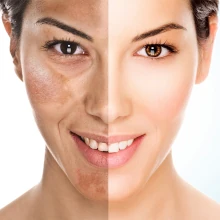 Acne e Melasma